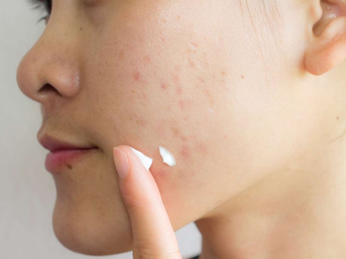 Best Home remedy to get rid of acne scars and pimple marks: - Fashion Res. 